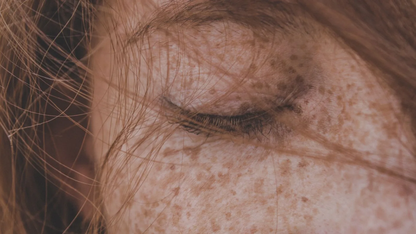 Ergenlik Döneminde Akne Gelişimi ve Sebum Üretimi: Cilt Bariyerini Korumak İçin Ne Yapılmalı? detay görseli