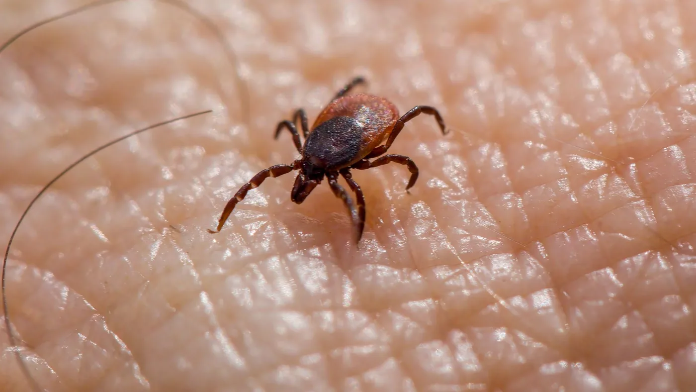 Lyme Hastalığı ve Kenelerin Vücutta Bıraktığı Dermatolojik İzler detay görseli