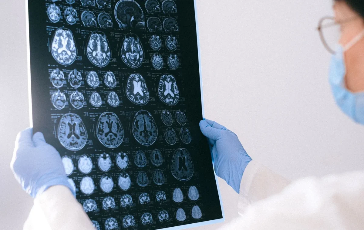 Trigeminal Nevralji Belirtileri: Yüzdeki Şimşek Çakar Tarzdaki Ağrılar